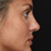 Rinoplastia Antes y Después: Galería Completa Caso 66