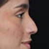 Rinoplastia Antes y Después: Galería Completa Caso 2