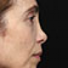 Rinoplastia Antes y Después: Galería Completa Caso 65
