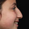 Rinoplastia Antes y Después: Galería Completa Caso 22