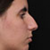 Rinoplastia Antes y Después: Galería Completa Caso 28