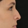 Rinoplastia Antes y Después: Galería Completa Caso 4