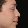 Rinoplastia Antes y Después: Galería Completa Caso 3