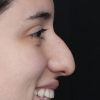 Rinoplastia Antes y Después: Galería Completa Caso 17