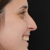 Rinoplastia Antes y Después: Galería Completa Caso 53
