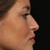 Rinoplastia Antes y Después: Galería Completa Caso 70
