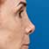 Rinoplastia Antes y Después: Galería Completa Caso 51