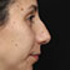 Rinoplastia Antes y Después: Galería Completa Caso 140