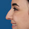 Rinoplastia Antes y Después: Galería Completa Caso 36