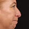 Rinoplastia Antes y Después: Galería Completa Caso 136