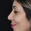 Rinoplastia Antes y Después: Galería Completa Caso 33