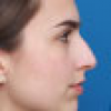 Rinoplastia Antes y Después: Galería Completa Caso 12