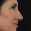 Rinoplastia Antes y Después: Galería Completa Caso 47