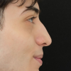 Rinoplastia Antes y Después: Galería Completa Caso 34