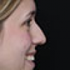 Rinoplastia Antes y Después: Galería Completa Caso 49