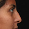 Rinoplastia Antes y Después: Galería Completa Caso 43