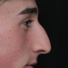 Rinoplastia Antes y Después: Galería Completa Caso 11