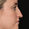 Rinoplastia Antes y Después: Galería Completa Caso 63