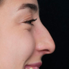 Rinoplastia Antes y Después: Galería Completa Caso 7