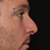 Rinoplastia Antes y Después: Galería Completa Caso 74