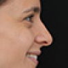 Rinoplastia Antes y Después: Galería Completa Caso 75