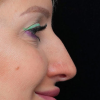 Rinoplastia Antes y Después: Galería Completa Caso 24